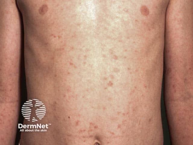 Pityriasis lichenoides chronica on the chest 