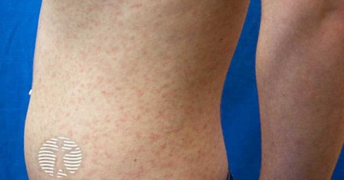 Plc Rash Pityriasis lichenoides image