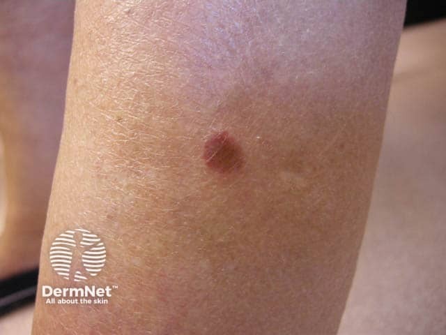 Close up of an early pityriasis lichenoides acuta lesion on the leg