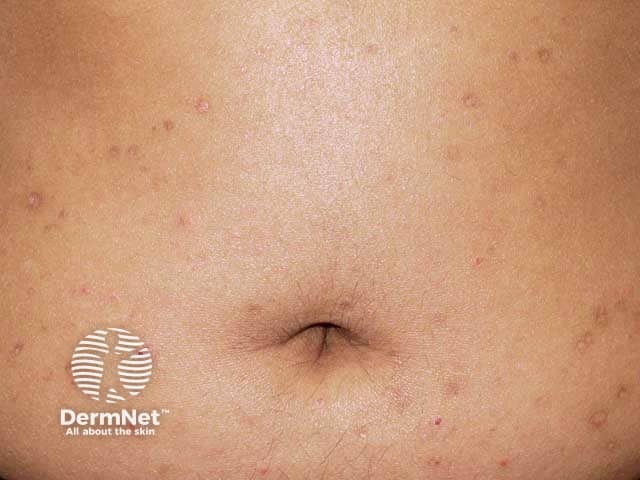 Pityriasis lichenoides chronica on the abdomen