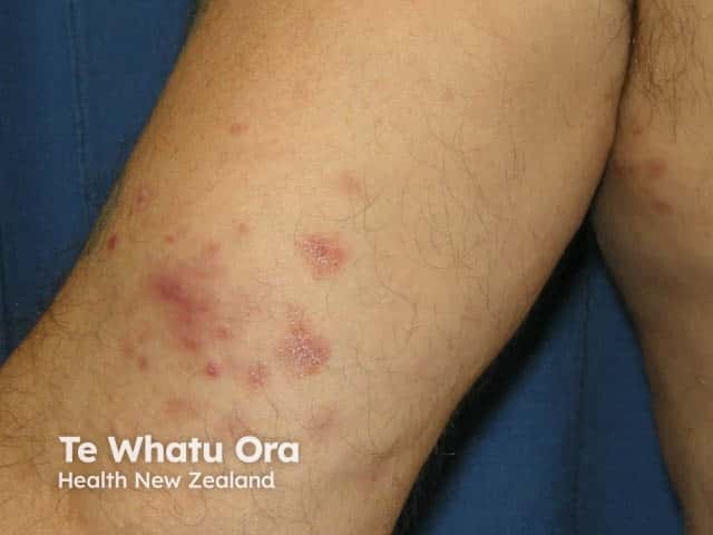 Inflammatory lesions in pityriasis lichenoides acuta on the arm