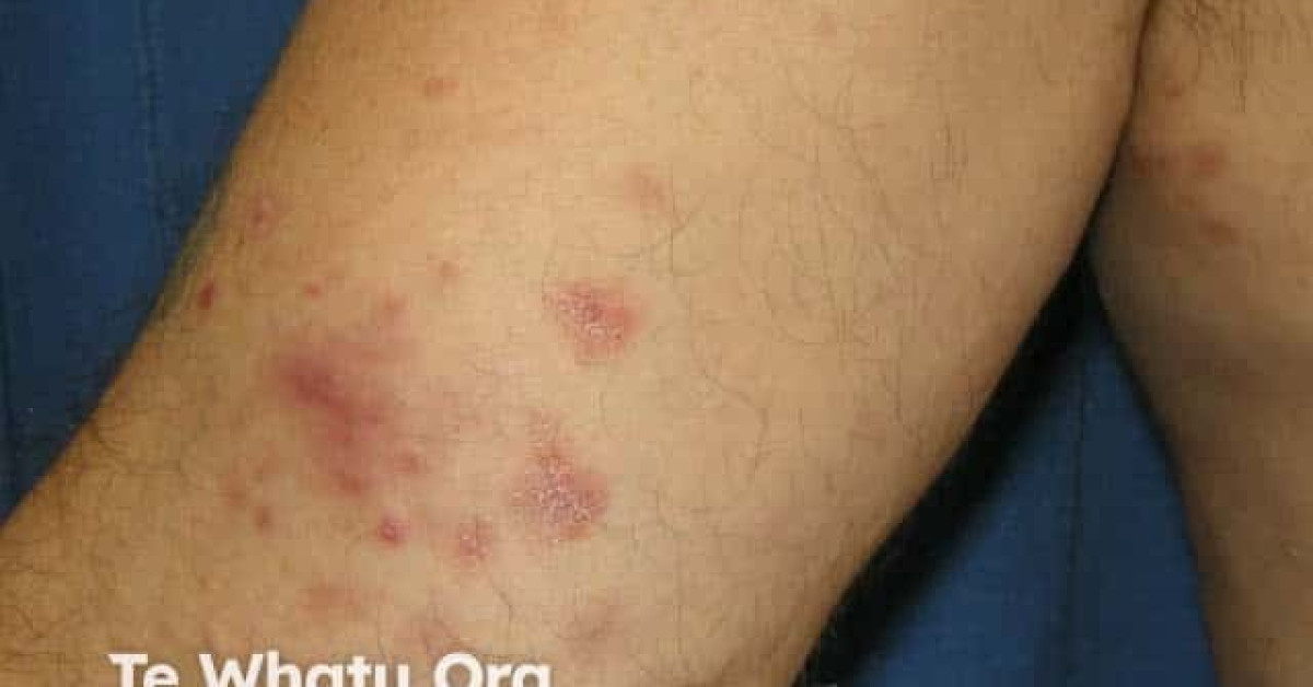 Pityriasis lichenoides image