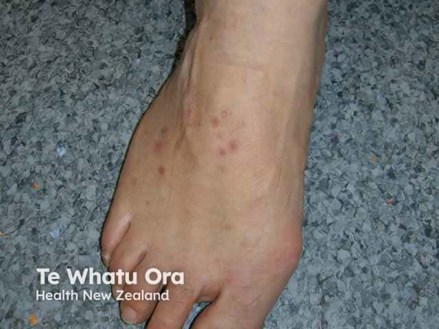 Pityriasis lichenoides acuta on the dorsal foot