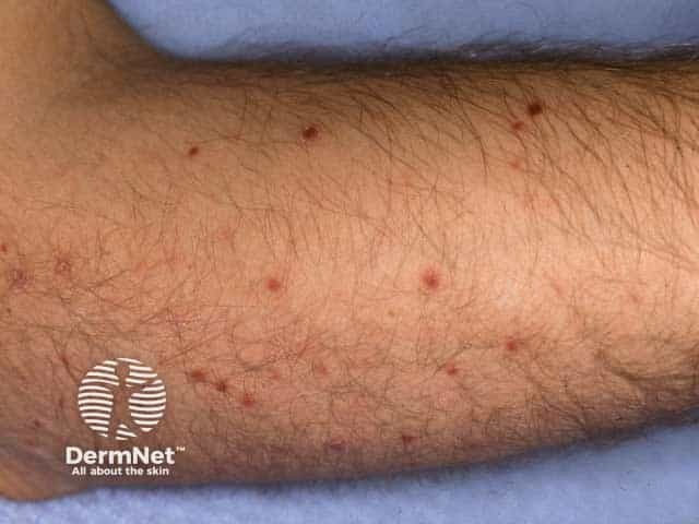 Pityriasis lichenoides chronica on the arm