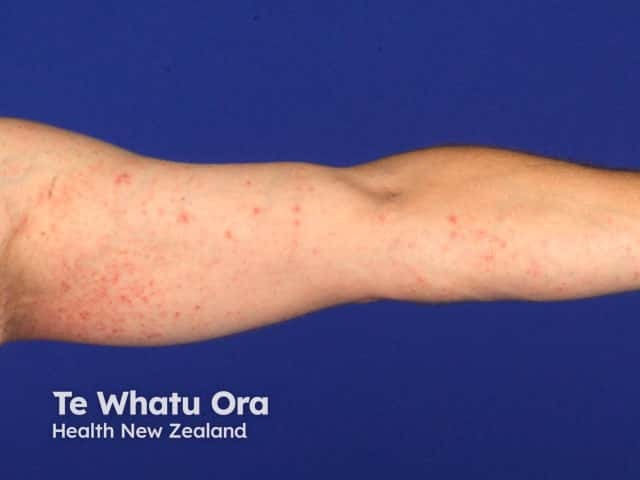 Inner upper arm pityriasis lichenoides chronica - a common site for this eruption