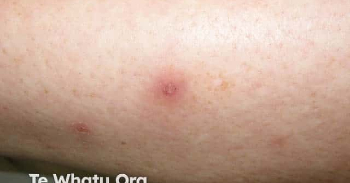 Plc Rash Pityriasis lichenoides image