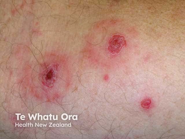 Eroded lesions in pityriasis lichenoides acuta