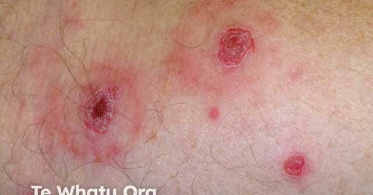 Pityriasis Lichenoides Image