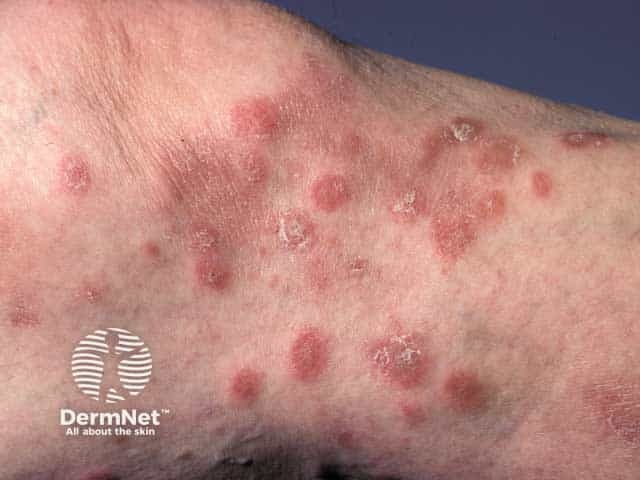 Pityriasis lichenoides chronica on the legs