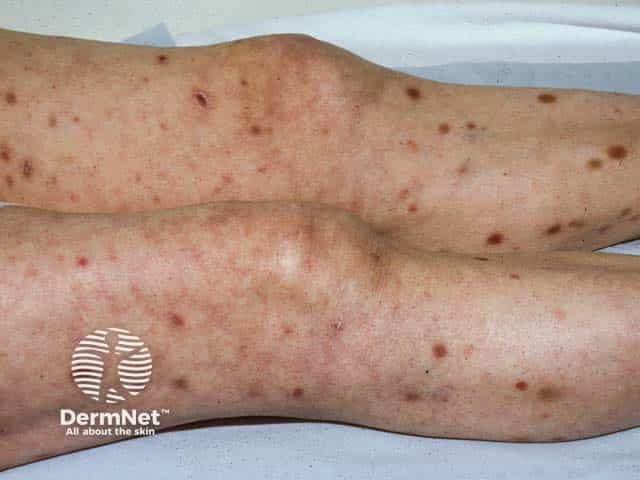 Pityriasis lichenoides acuta on the legs