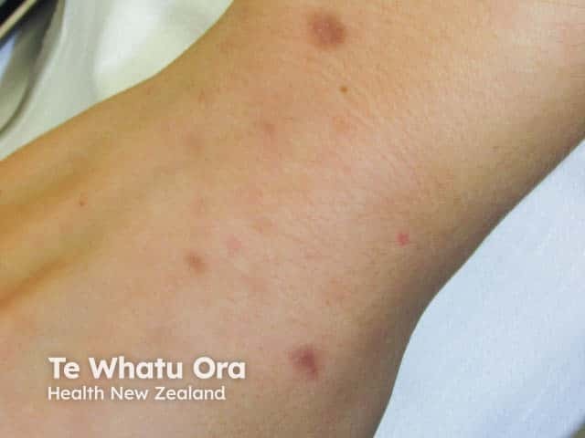 Pityriasis lichenoides acuta on the wrist