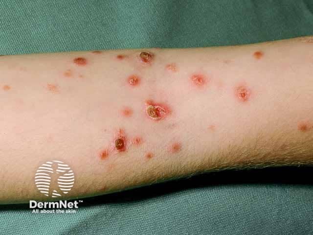 Ulcerated pityriasis lichenoides acuta on the arm