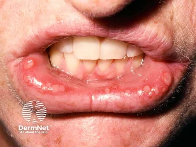 Mucosal ulcers in pityriasis lichenoides acuta