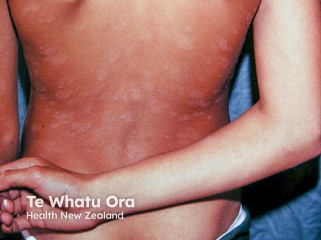 Hypopigmented pityriasis rosea in skin of colour