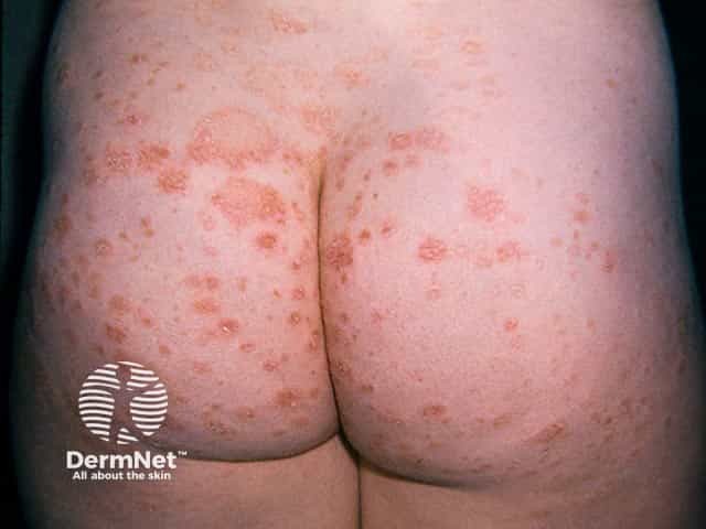 Pityriasis rosea on the buttocks