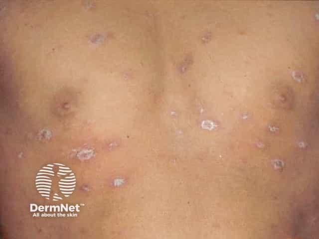 Annular scaly patches in pityriasis rosea in skin of colour