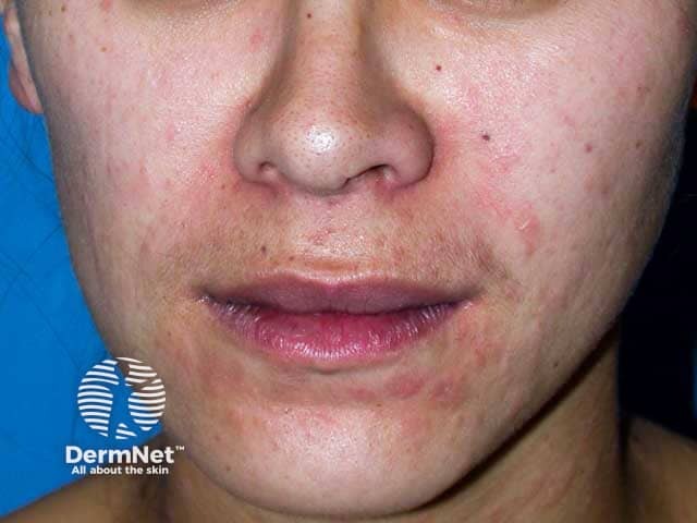 Facial lesions in pityriasis rosea