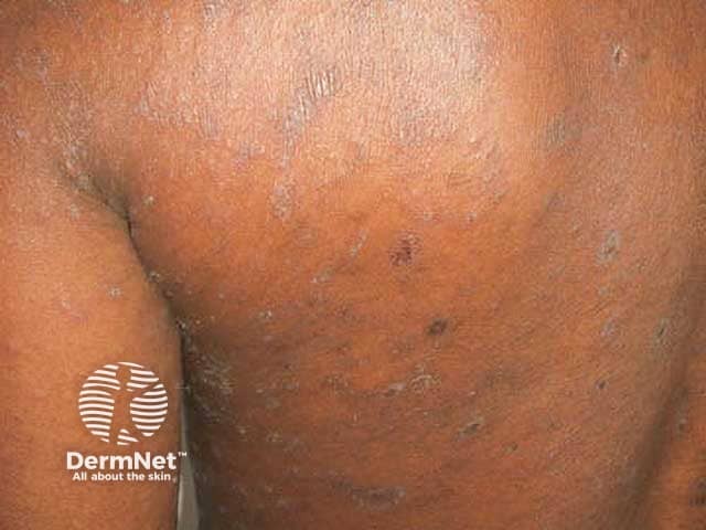 Extensive pityriasis rosea on the chest