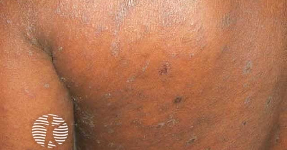 pityriasis-rosea-image