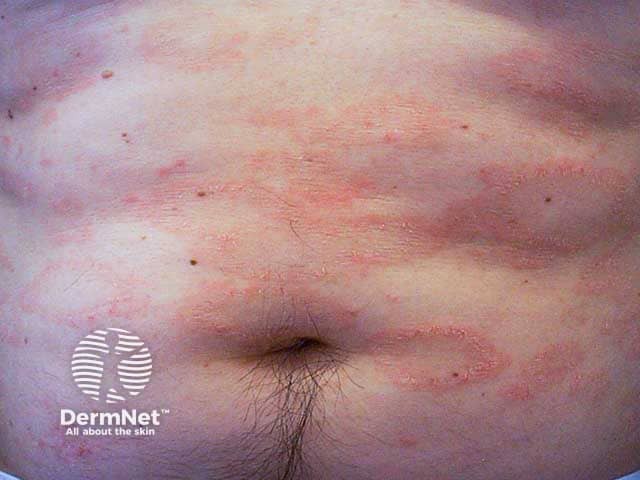 Annualr scaly patches in pityriasis rosea