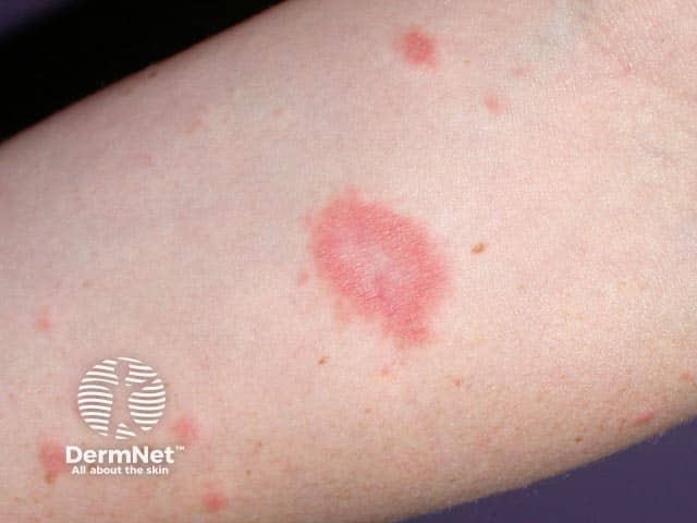 The herald patch of pityriasis rosea