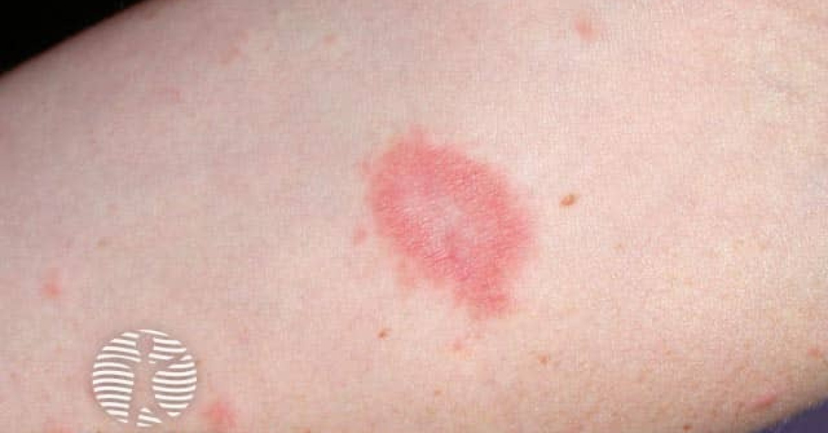 Pityriasis Rosea Image