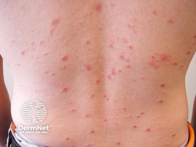 Pityriasis rosea on the back