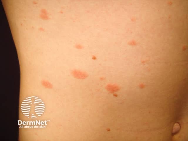 Oval lesions of pityriasis rosea on the abdomen