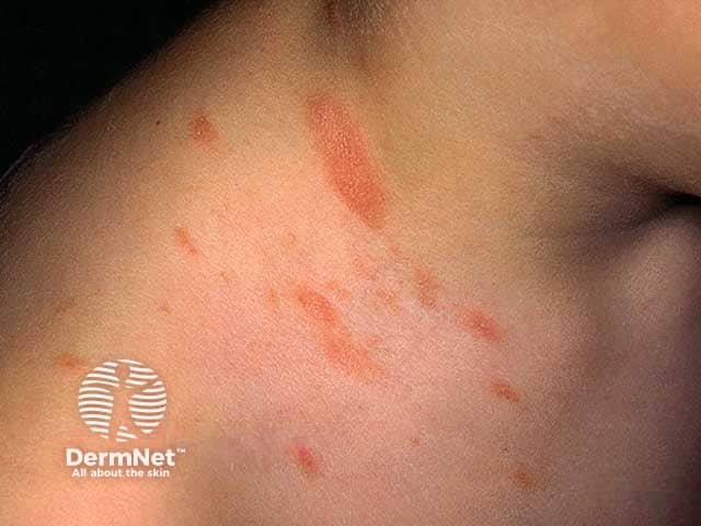 Pityriasis rosea on the neck