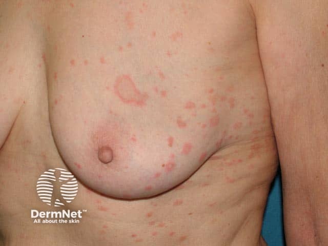 Pityriasis rosea and a herald patch on the breast