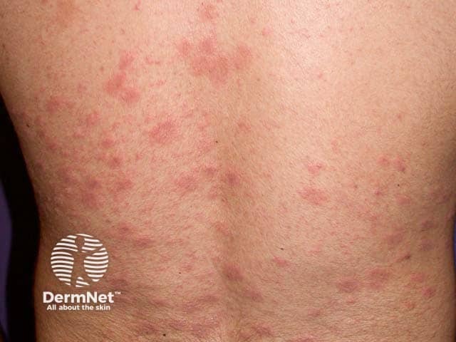 Pityriasis rosea on the back