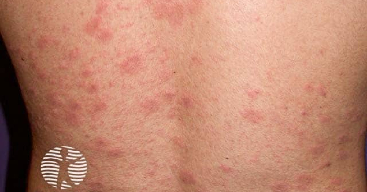 pityriasis-rosea-image