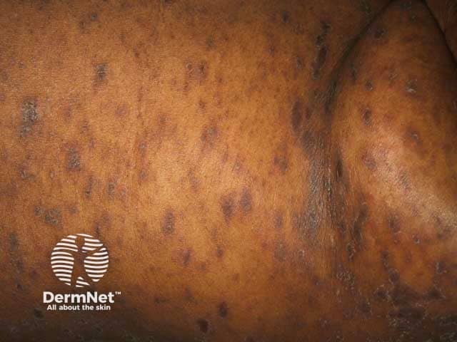 Pigmented lesions of pityriasis rosea in skin of colour