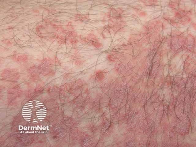 Atypical pityriasis rosea