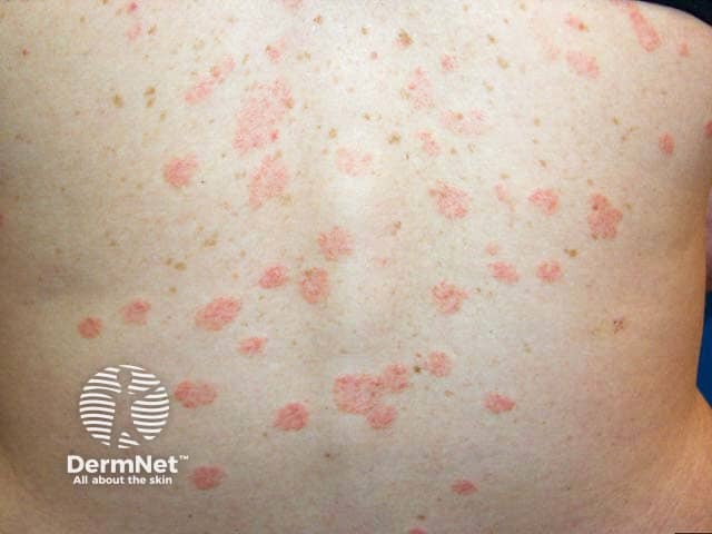 Pityriasis Rosea Images DermNet Pityriasis Rosea Images DermNet
