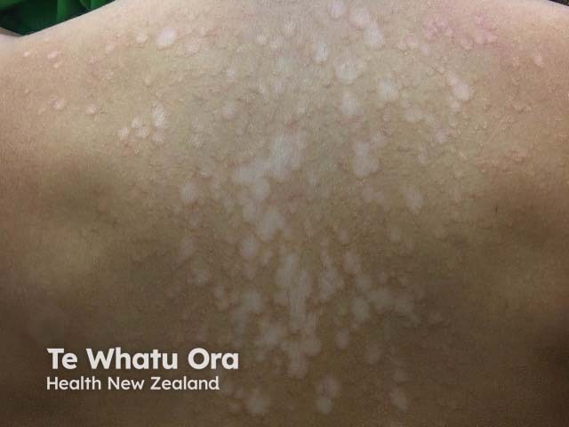Fine pale scaly lesions of pityriasis versicolor