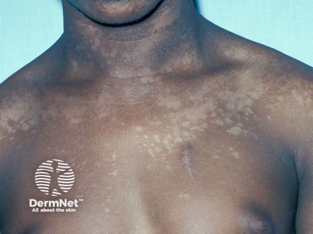 Depigmentation due to pityriasis versicolor on the upper trunk