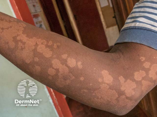 Hypopigmented pityriasis versicolor on the arm