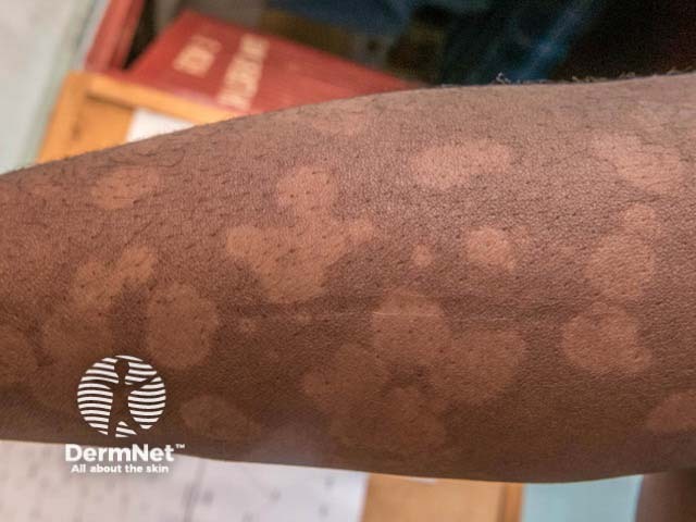 Hypopigmented pityriasis versicolor on the arm