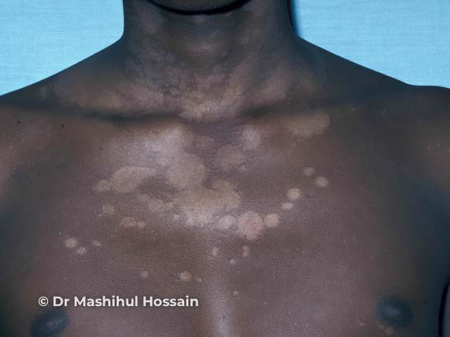 Hypopigmented patches on the chest due to pityriasis versicolor