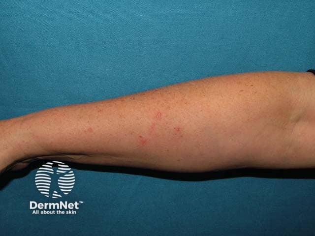 Rhus tree contact allergy: linear rash on arm