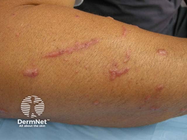 Rhus tree contact allergy: linear streaks on arm