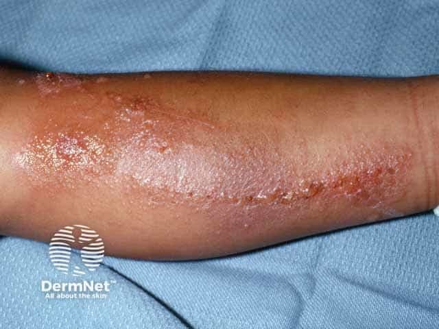 Rhus tree contact allergy: linear blisters on leg