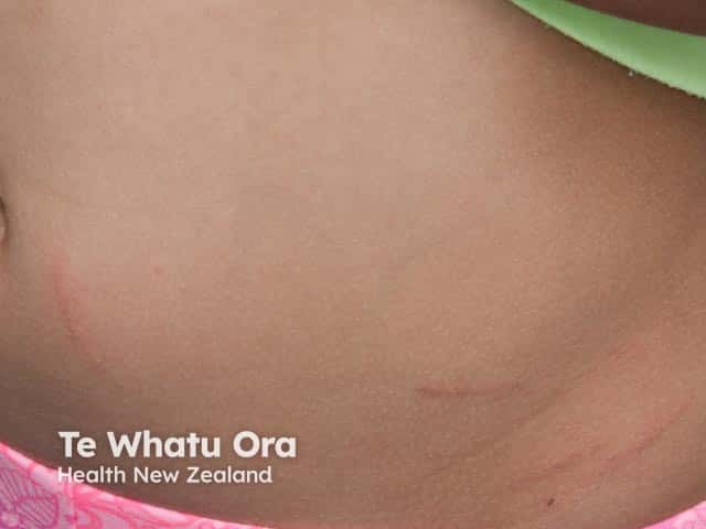 Rhus tree contact allergy: linear rash on abdomen