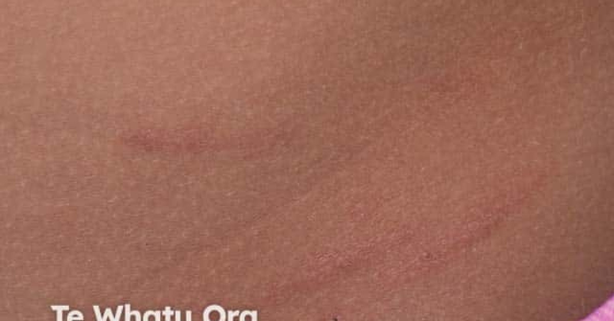 Plant dermatitis image