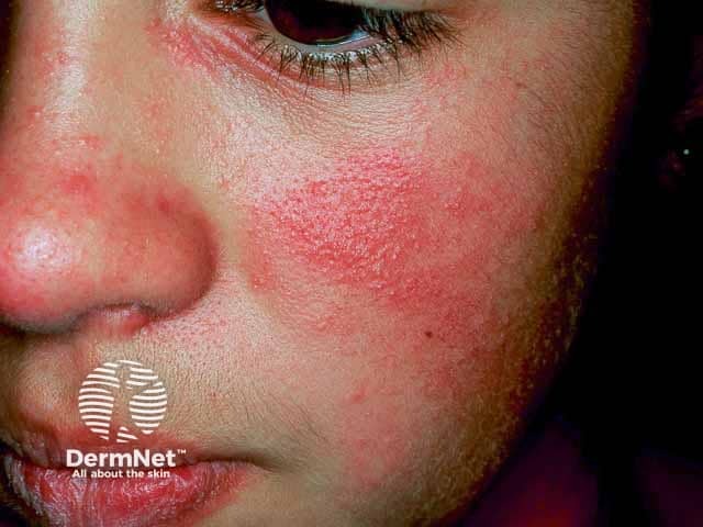 Plant dermatitis image