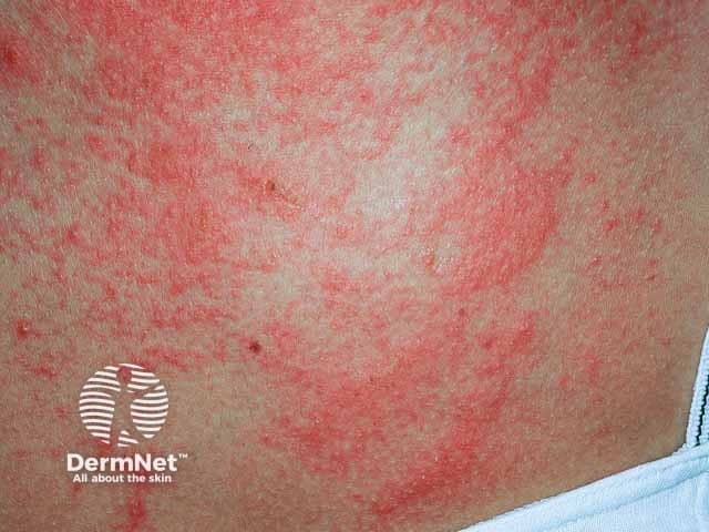 Plant dermatitis image