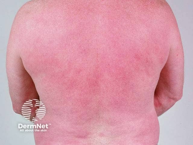 Rhus tree contact allergy: diffuse erythema