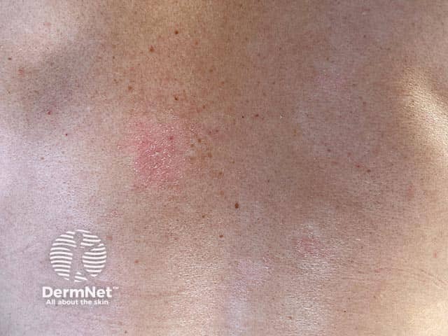 Early superficial plaques of psoriasis on the back - gentle scratching will accentuate the typical silvery scale