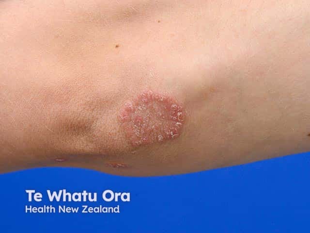 Dermnet Nz DermNet dermnetnz X Dermnet Nz DermNet dermnetnz X